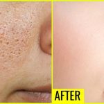 A before-and-after comparison showing the successful reduction of enlarged facial pores and improvement in skin texture following professional dermatological treatment.