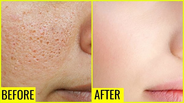 Effective Strategies to Reduce Facial Pores