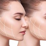 A professional medical illustration showing jawline contouring lines on a patient's profile, representing plastic surgery consultation and aesthetic planning.