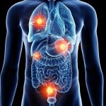 Human anatomy diagram showing neuroendocrine tumor sites highlighted in the lungs and digestive tract
