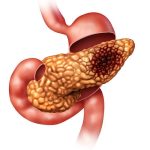 Medical illustration of human anatomy showing a malignant tumor lesion developing on the tissue of the pancreas