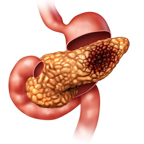 Early Warning Signs of Pancreatic Cancer