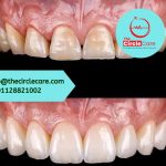 before-and-after close-up showing the professional results of dental veneers and teeth whitening, demonstrating significant aesthetic improvement in tooth color and alignment.
