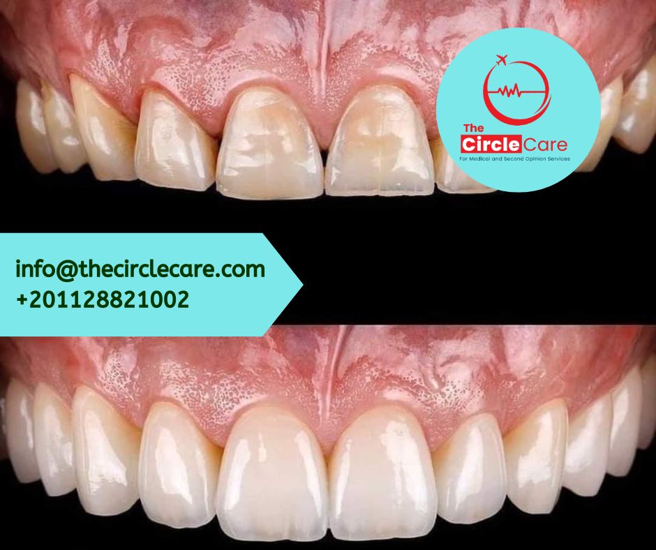 Dental Veneers in Egypt | Natural-Looking Smile Makeover