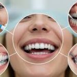 Collage showcasing various cosmetic dental treatments including teeth whitening, porcelain veneers, dental crowns, and clear braces