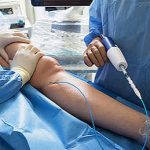 Surgeon performing a minimally invasive endovenous laser varicose vein treatment on a patient's leg