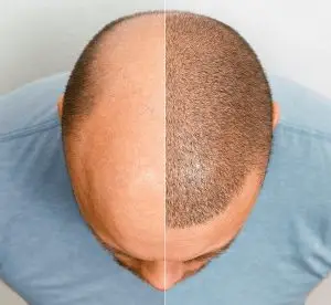 زراعة الشعر