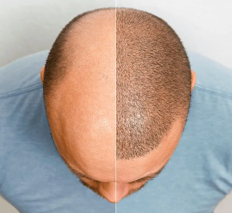 Hair Transplant: Your Journey to a Fuller, Confident You-for $200 usd