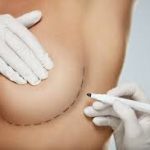 Cosmetic surgeon in white gloves using a marker to draw surgical guidelines on a female patient's breast before surgery