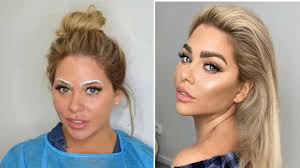 Eyebrow Transplant