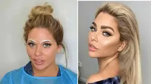 Eyebrow Transplant: Your Path to Perfect Arches-just at $750 usd