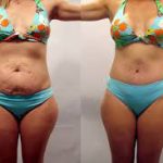 صورة مقارنة قبل وبعد لإجراء تجميلي متكامل (Mommy Makeover) تظهر نتائج شد البطن وتنسيق القوام بعد الحمل.