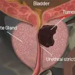 Medical 3D cross-section diagram of male anatomy showing a localized prostate cancer tumor lesion causing a urethral stricture near the bladder