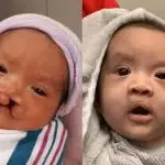 Before and after comparison photos of an infant showing the transformative facial reconstruction results of a cleft lip repair surgery