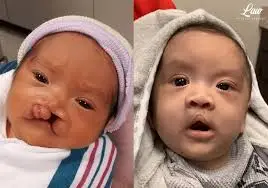 cleft lip