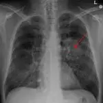 Medical chest X-ray scan showing a highlighted lung cancer tumor mass in the left lung indicated by a red arrow