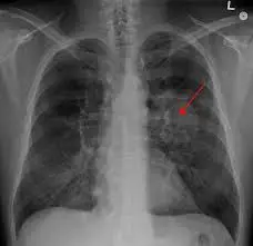 Lung Cancer Treatment in Germany: Advanced Care & Top Specialists