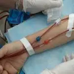 طبيب يقوم بفحص وإعداد الوصلة الشريانية الوريدية في ذراع المريض لإجراء جراحة أو قسطرة علاجية تندرج ضمن تخصص جراحة الأوعية الدموية