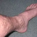 Close-up of a patient's lower leg and ankle showing visible, swollen, and twisted varicose veins on the skin surface