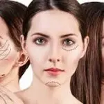 صورة مجمعة لثلاث زوايا مختلفة لوجه امرأة تظهر عليها خطوط التنقيط المحددة لعملية شد الوجه التجميلية بالخيوط.