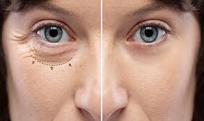 تجميل الجفون