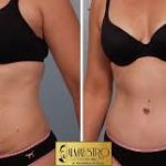 صورة مقارنة قبل وبعد لإجراء تجميلي متكامل (Mommy Makeover في مصر)، تبرز نتائج شد الجلد ونحت الجسم وتنسيق القوام.