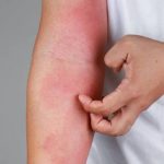 A person scratching an irritated, red patch of skin on their arm, characteristic of an eczema flare-up.