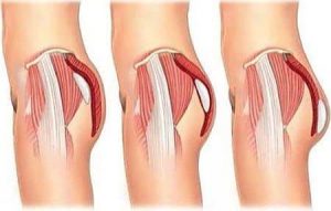 A medical illustration comparing three different placements and types of buttock implants within the gluteal muscle.