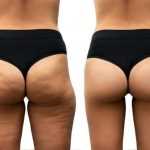A side-by-side comparison showing the appearance of skin before and after cellulite treatment.