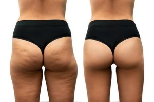 A side-by-side comparison showing the appearance of skin before and after cellulite treatment.