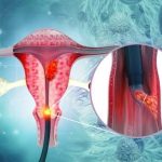 A medical illustration showing a gynecological procedure inside the uterus, with an inset zoomed-in view of a specialized surgical instrument removing an abnormal lesion or growth from the cervix.
