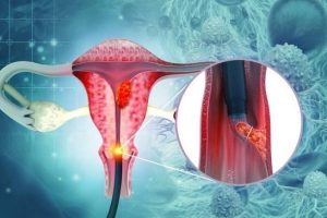 cervical cancer