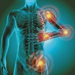 Human body silhouette highlighting areas of chronic inflammation in the shoulders, elbows, hands, and pelvic region
