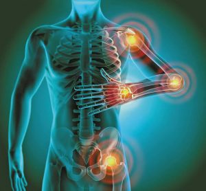 Human body silhouette highlighting areas of chronic inflammation in the shoulders, elbows, hands, and pelvic region
