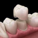 3D dental illustration showing a ceramic dental crown being placed over a prepared tooth structure along the lower gumline to restore and protect a damaged tooth.