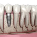 A detailed medical cross-section diagram of a lower jawline showing a titanium dental implant post anchored securely inside the jawbone, topped with an abutment and a realistic prosthetic porcelain tooth crown.