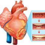 A medical illustration showing heart anatomy and the stages of plaque buildup within arteries, indicating heart disease progression.