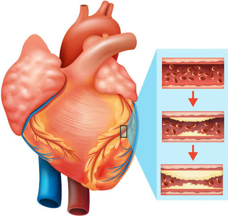 Treatment for heart disease using stem cells
