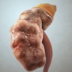 A detailed medical anatomical rendering of a human kidney showing signs of disease, inflammation, or damage to its surface structure.
