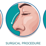Medical illustration diagram showing the stages of a rhinoplasty nose surgery procedure, including side-profile views of the nose bridge shape before, during, and after surgical modification.