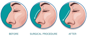 nose surgery