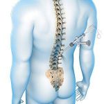 Medical illustration of a minimally invasive spine surgery procedure targeting the lumbar vertebrae