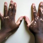 صورة مقربة ليدين تعانيان من بقع بيضاء واضحة نتيجة الإصابة بمرض البهاق (Vitiligo) الذي يؤدي إلى فقدان صبغة الميلانين في الجلد.