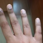 صورة توضح اسمرار الجلد حول أظافر اليدين، وهي حالة جلدية قد ترتبط بالجفاف أو نقص فيتامين ب12 أو عادات يومية معينة.