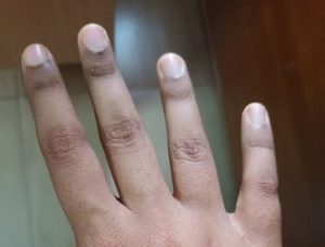 صورة توضح اسمرار الجلد حول أظافر اليدين، وهي حالة جلدية قد ترتبط بالجفاف أو نقص فيتامين ب12 أو عادات يومية معينة.