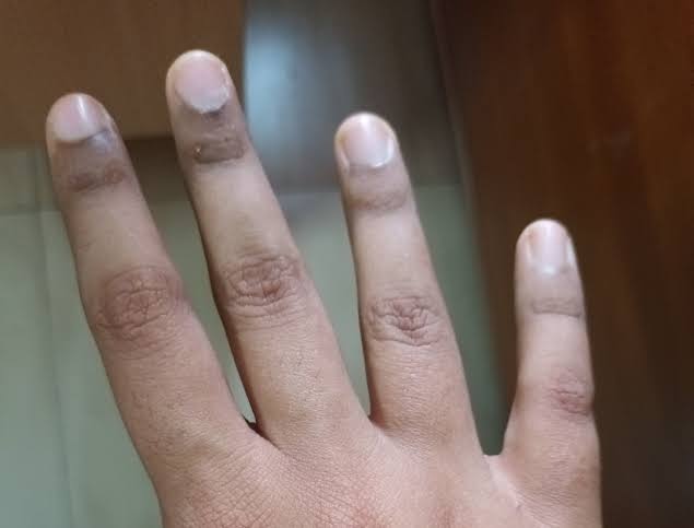 ما سبب سواد الجلد حول الأظافر؟ الأسباب الشائعة، طرق العلاج، ومتى يجب زيارة الطبيب